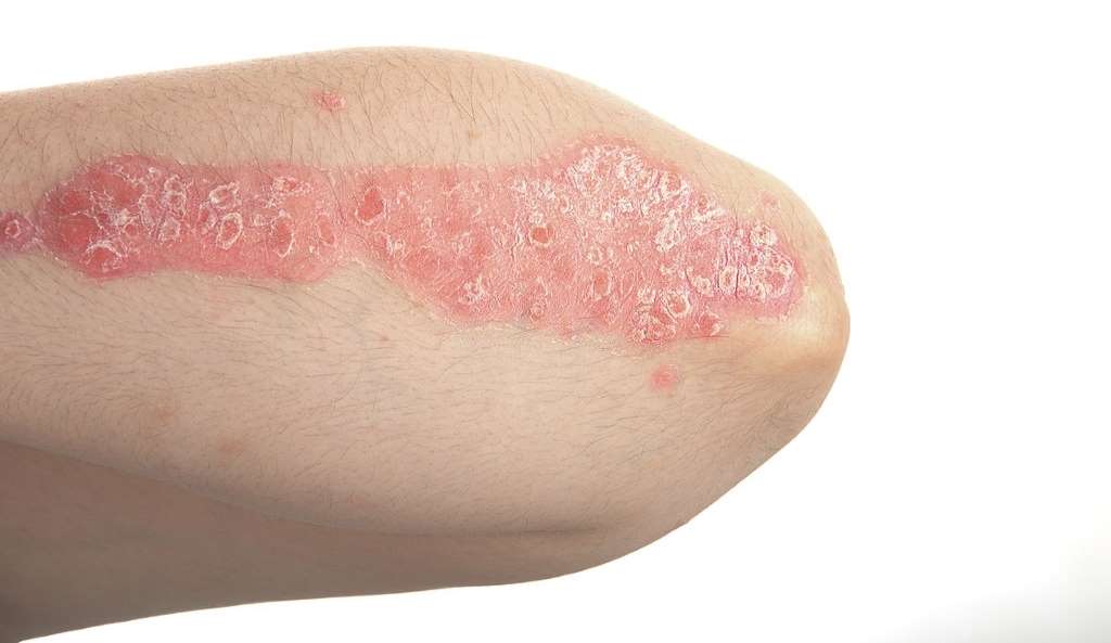 CBD Products for Psoriasis – Everything about Autoimmune Disorder, #1 USA Cannabidiol Blog CBD Products for Psoriasis, CBD Products for Psoriasis – Everything about Autoimmune Disorder, #1 USA Cannabidiol Blog