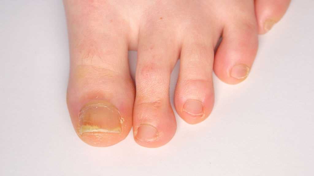 CBD Oil for Psoriatic Arthritis – How Does Cannabidiol Work?, #1 USA Cannabidiol Blog CBD Oil for Psoriatic Arthritis, CBD Oil for Psoriatic Arthritis – How Does Cannabidiol Work?, #1 USA Cannabidiol Blog